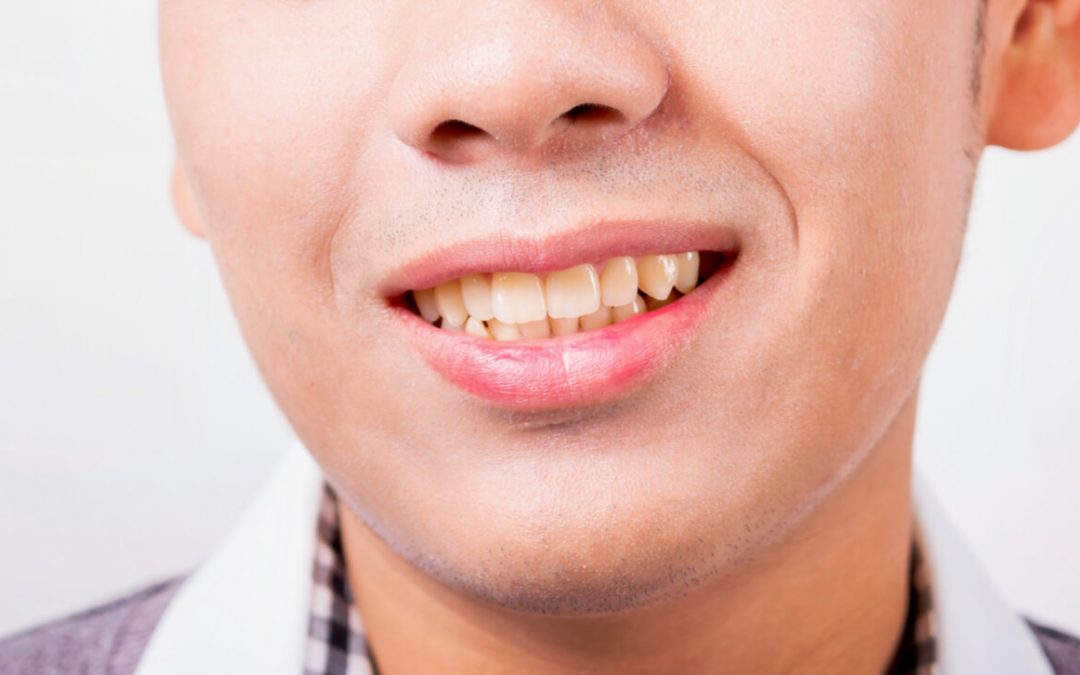 Why some people have naturally yellow teeth