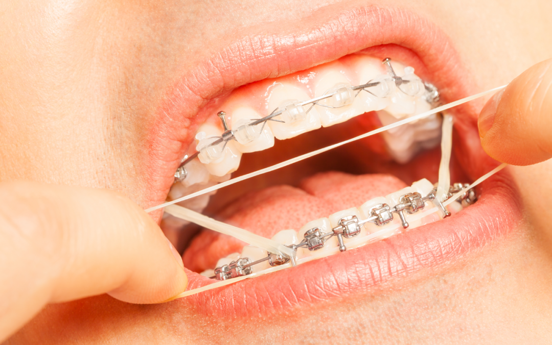 Orthodontic Band Induced Periodontitis