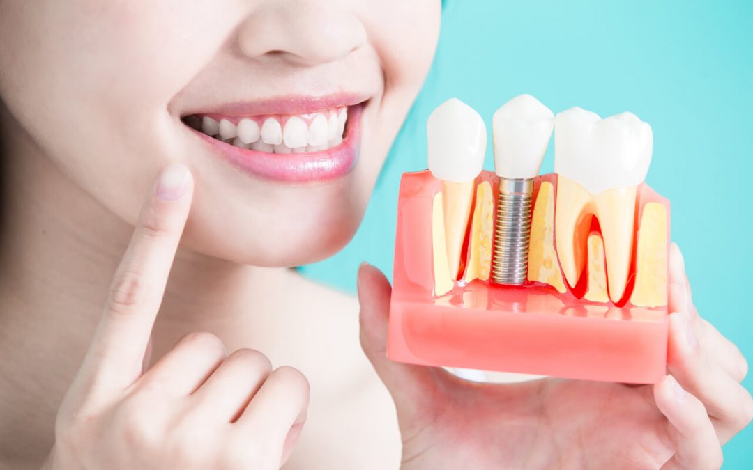 Finding cheap dental implants