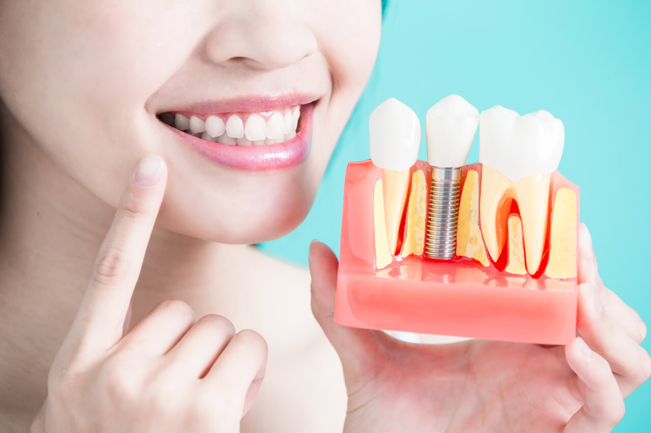 Finding cheap dental implants