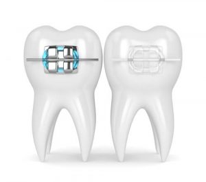 clear braces vs.metal braces