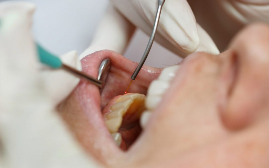 What is a Pinhole Gum Surgery?