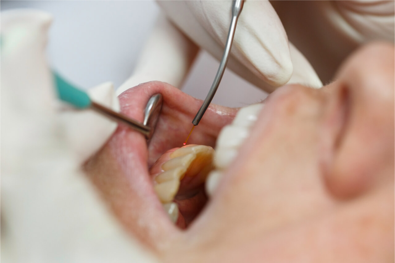 What is a Pinhole Gum Surgery?