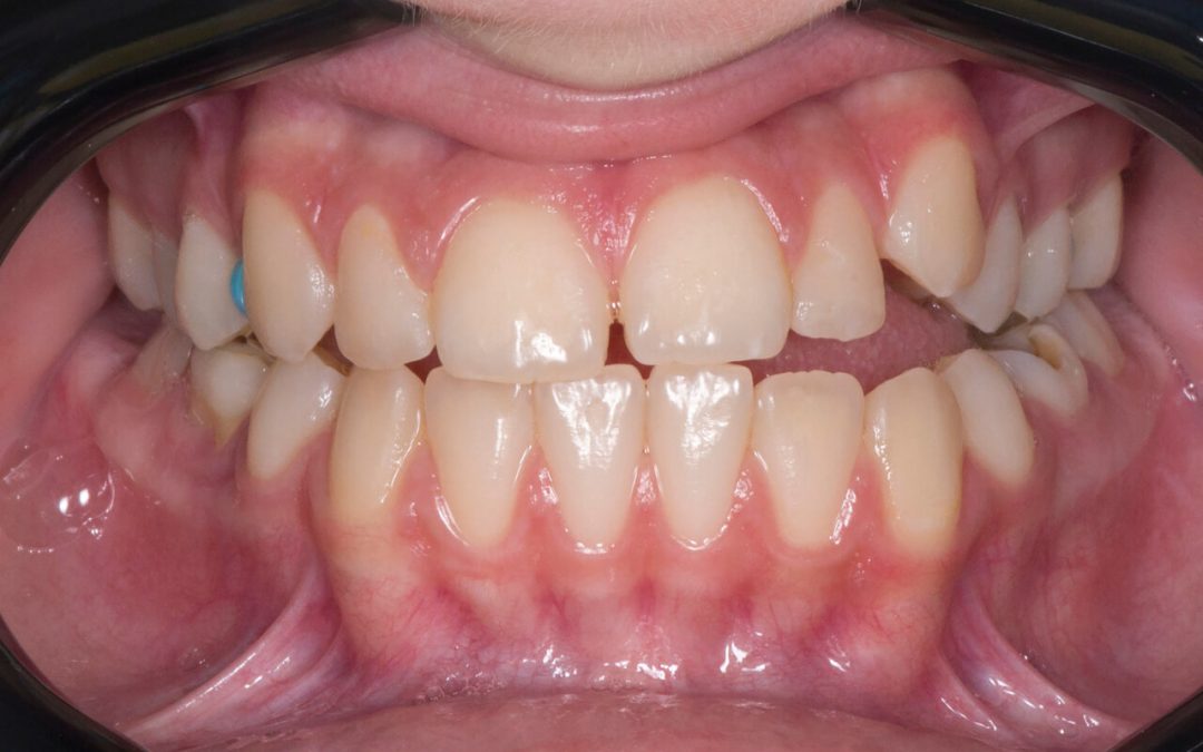 What are the benefits of Open Bite Braces