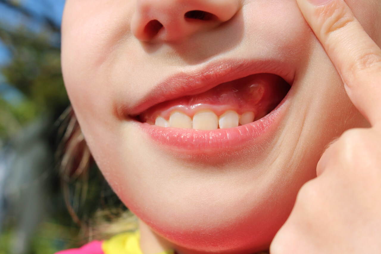 Gum infections that cause pus - North DeKalb Orthodontics