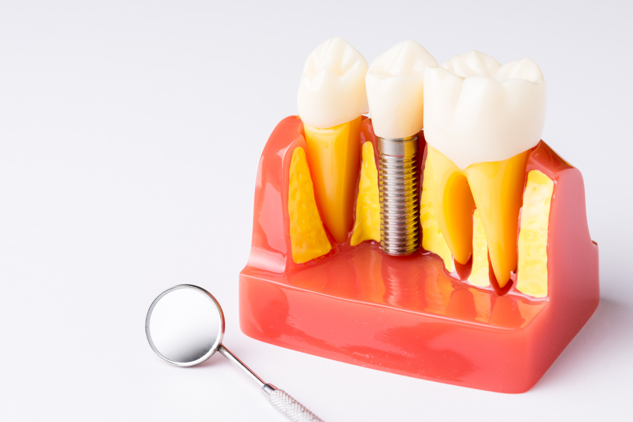 Dental Implant Removal