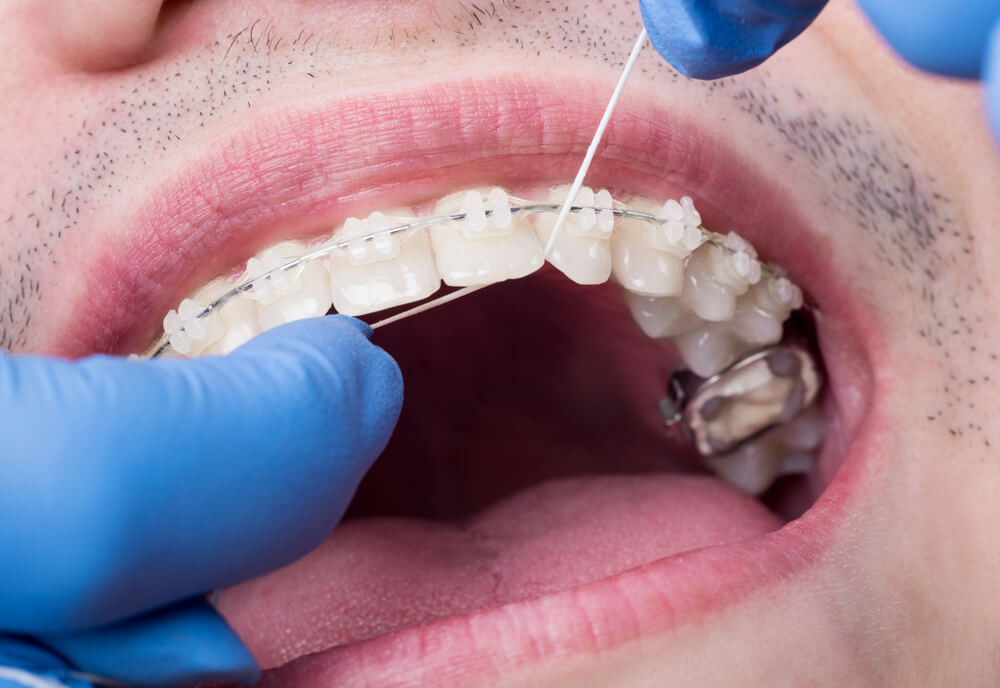 Types of Orthodontic Flossers and Their Advantages