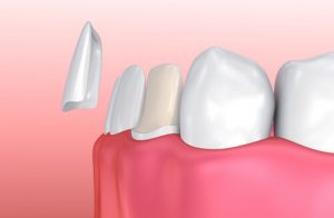 cost of veneers with insurance