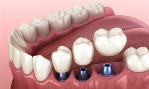 three dental crowns