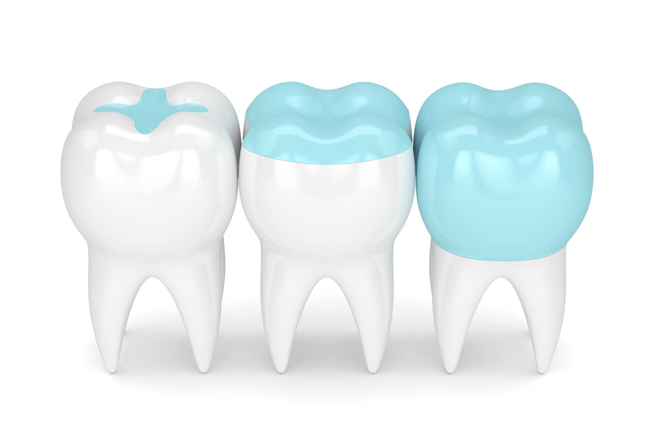 Onlay Vs Crown: Comparing Which Is A Better Option For Restoration