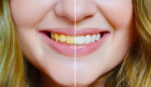 are teeth naturally yellow whitening